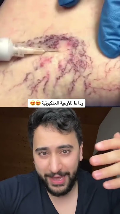 حقنة واحدة للتخلص من الدوالي السطحية 👌👌 | دكتور يوسف