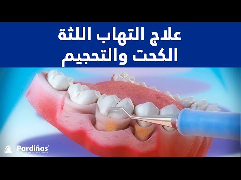 فيديو: في طب الأسنان ما هو التحجيم؟