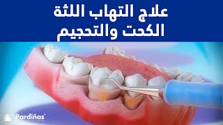 علاج كحت والتهاب اللثة C Youtube