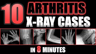 10 Arthritis X-Ray Cases in 8 minutes #radiology #arthritis #bones