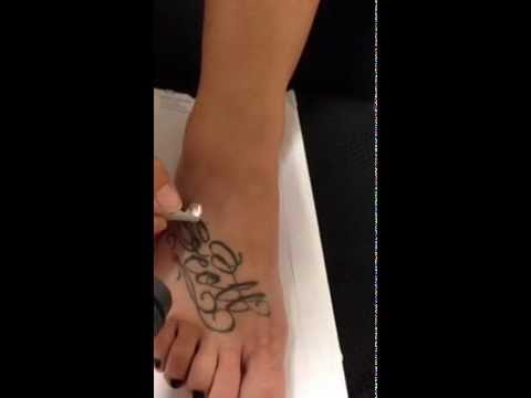 laser tattoo removal foot youtube laser tattoo removal foot youtube