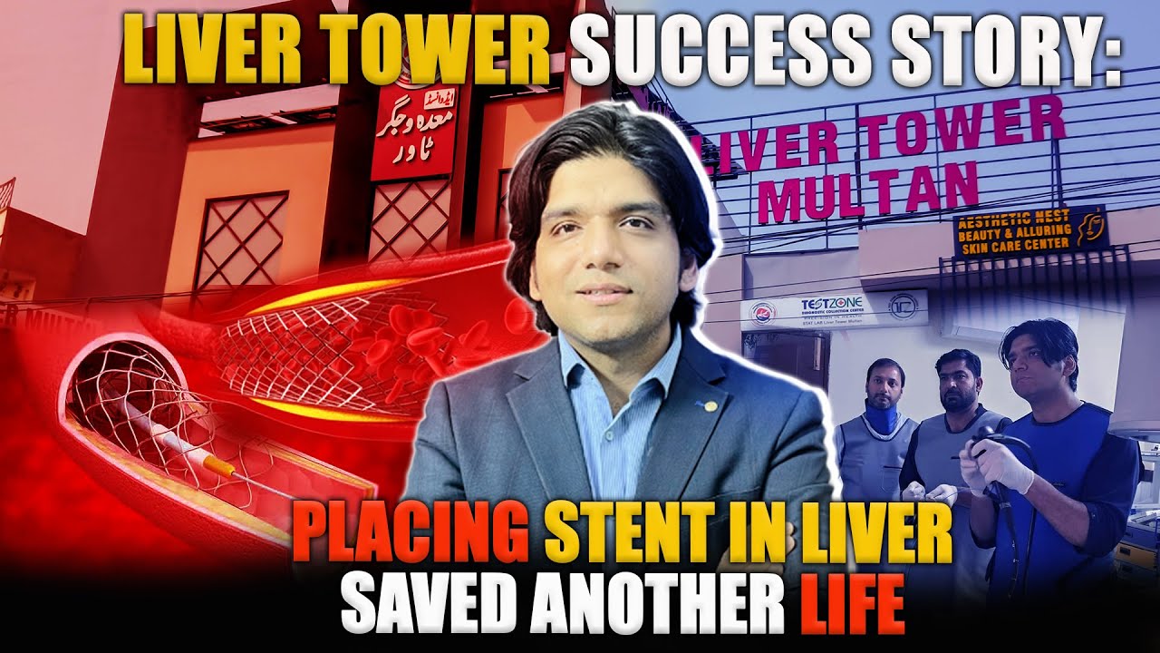 Liver tower success story: placing stent in liver saved another life ...