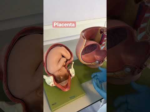 Video: Paano Makitungo sa Placenta Previa (na may Mga Larawan)
