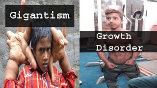 Growth hormone deficiency | Pituitary gland tumor symptoms | What is Gigantism