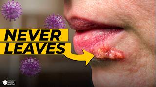 Herpes: Why It HIDES in Your Nerves Forever