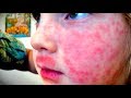 HORRIBLE ALLERGIC REACTION! (What to look out for when this happens) | Dr. Paul