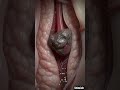 Painful Kidney Stone