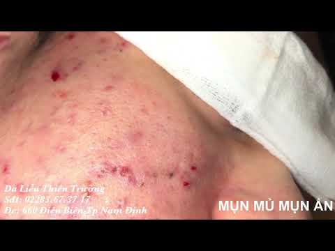 Video NẶN MỤN TRỨNG CÁ VIÊM, MỤN MỦ RẤT NẶNG - CLIP NẶN MỤN... - youtube