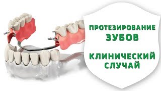 Съемное протезирование зубов. Реальная история лечения пациентки | Секреты стоматологии | Дентал ТВ