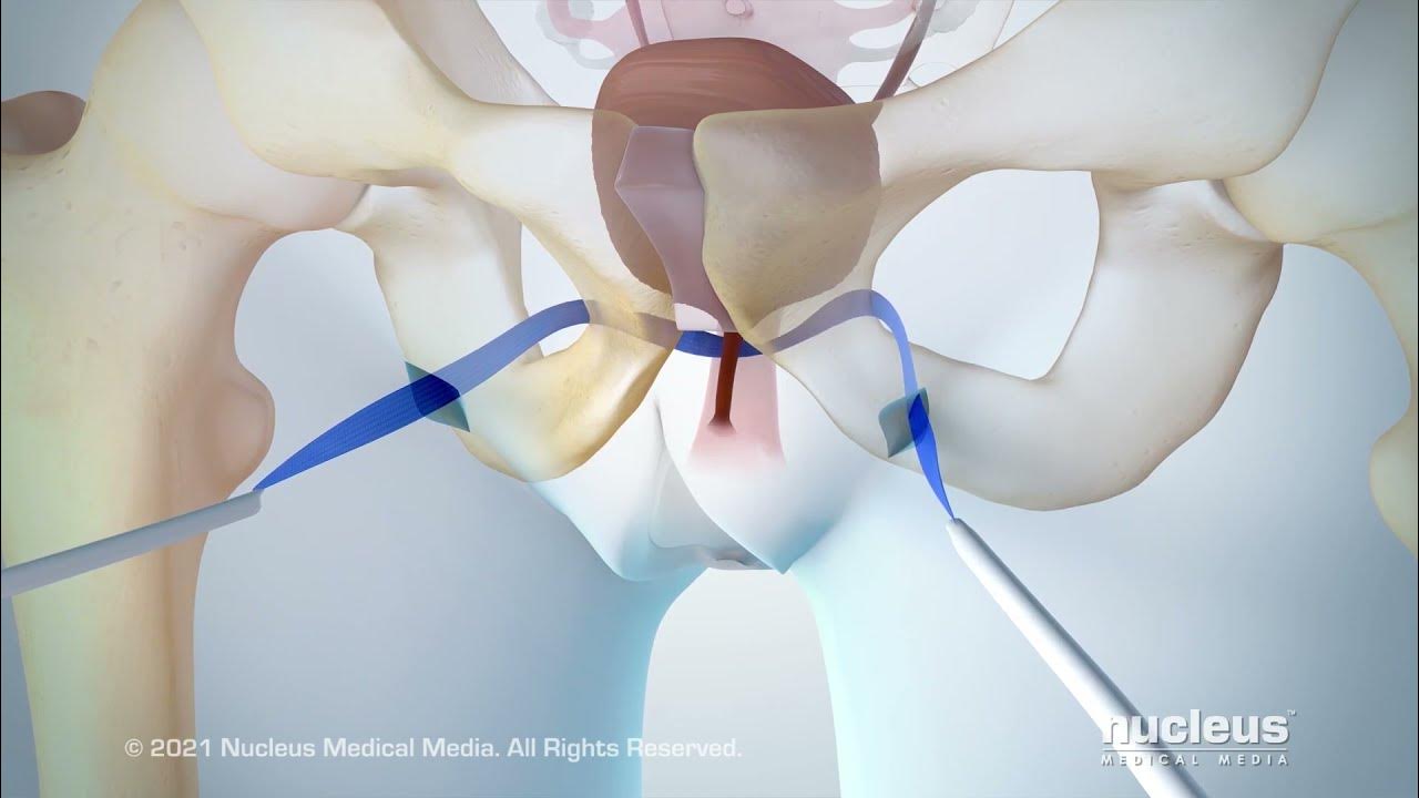 Urinary Incontinence Transobturator Tape (TOT) Procedure YouTube