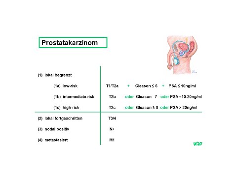 Video: Eine Kurzübersicht über Die Lebensqualität Als Ergebnis Von Prostatakrebsstudien: Patientenzentrierte Ansätze Sind Erforderlich, Um Geeignete Behandlungen Für Patienten Vorzuschlag