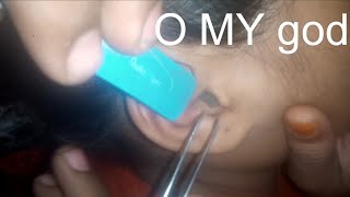 ASMR Emergency Ear Cleaning – You Can’t Hear?!