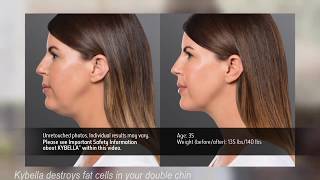 Kybella Cost Jonesboro AR Kybella Costs at Parkey and Davis