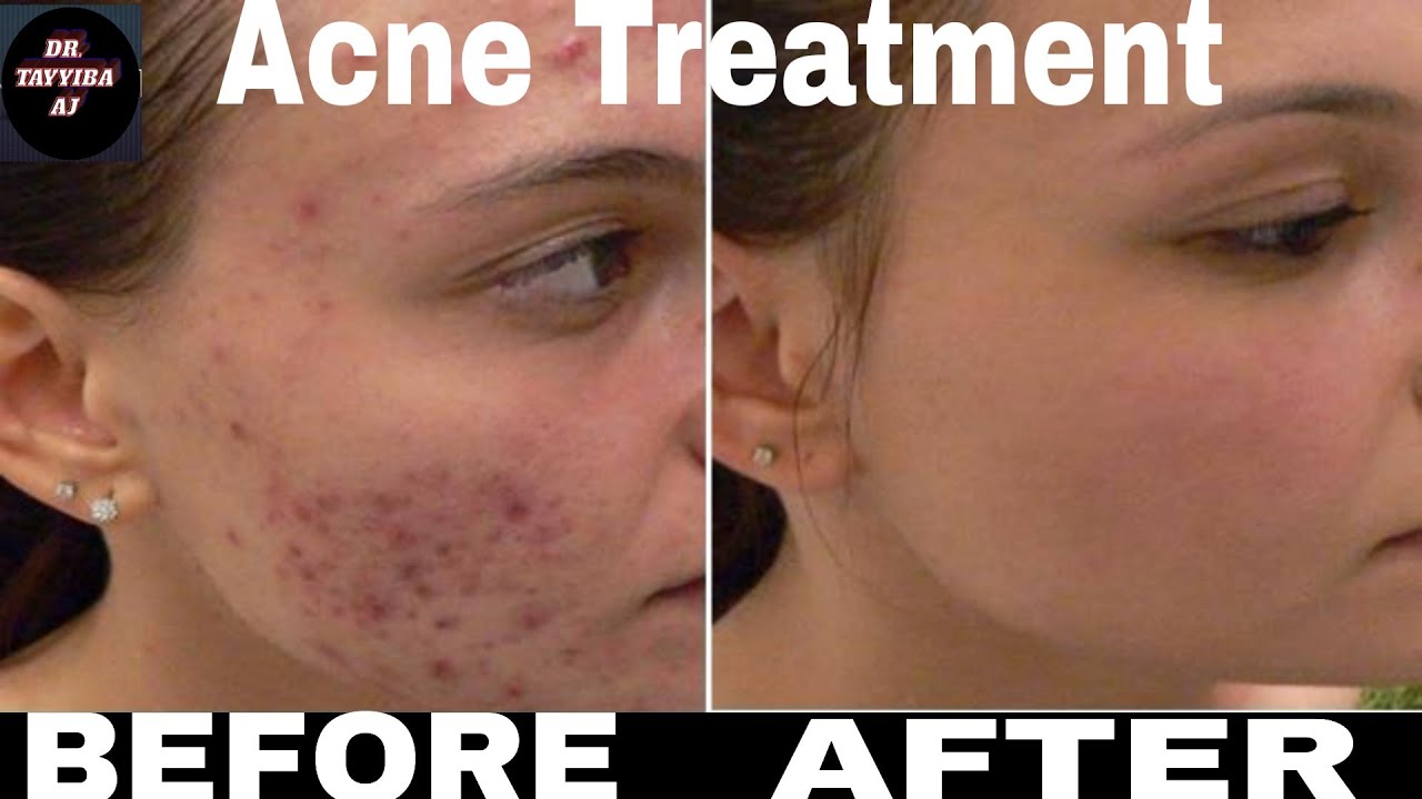 acne and pimples treatment 100% working - YouTube
