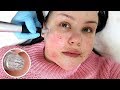 I Tried Microneedling for Acne Scars