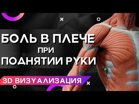 БОЛЬ В ПЛЕЧЕ ПРИ ПОДНЯТИИ РУКИ? АЛГОРИТМ ЛЕЧЕНИЯ