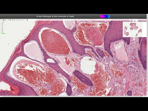 Angiokeratoma - Histopathology