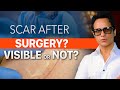 Is Scar Visible After Surgery? Scar Treatment Explained Clearly