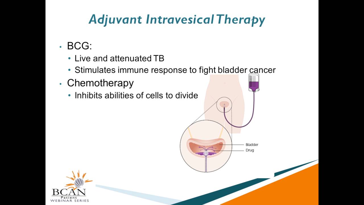 Highlighting Clinical Trials: Non-Muscle Invasive Bladder Cancer (Part II)