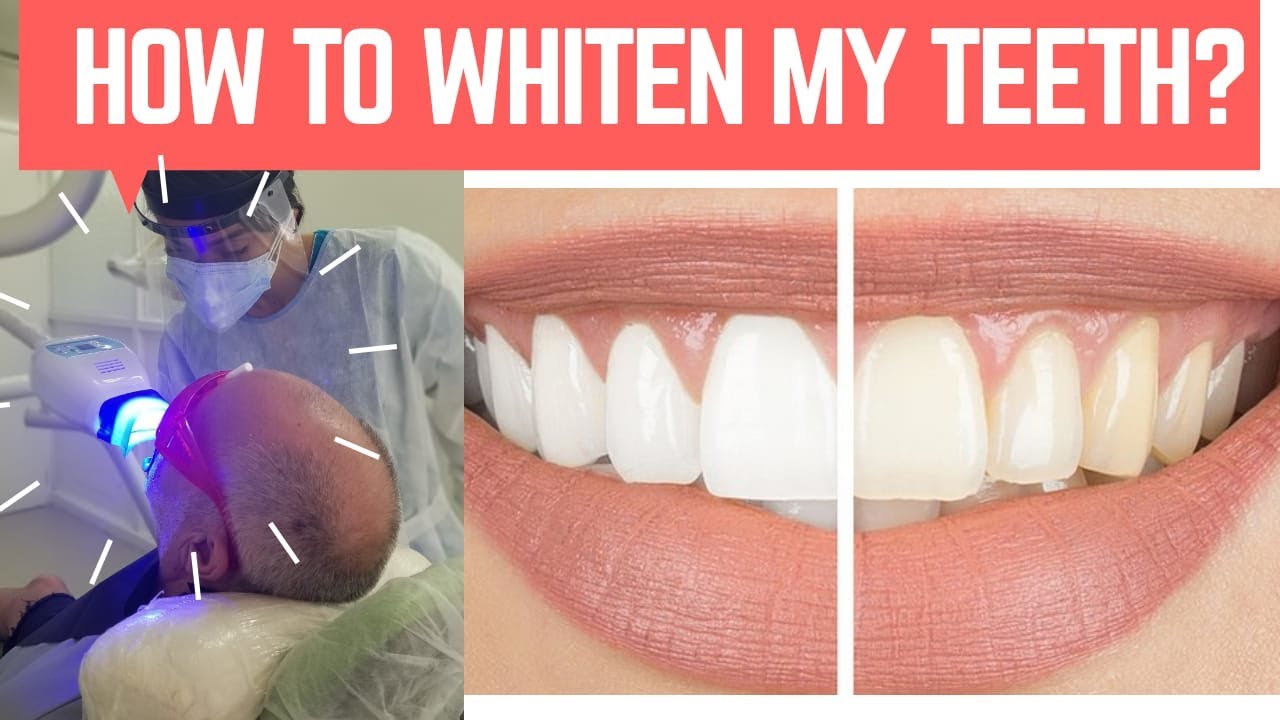HOW TO WHITEN MY TEETH INSTANTLY? TEETH WHITENING IN CARTAGENA HOW