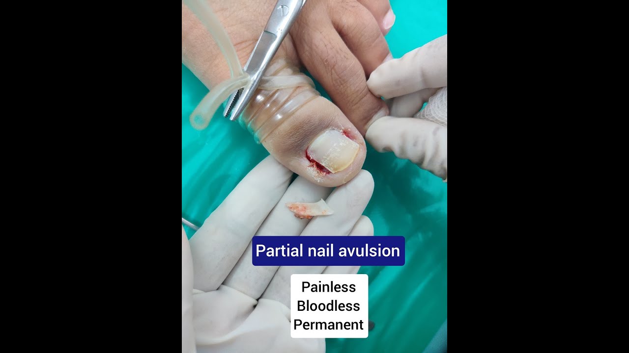 Ingrown toenail surgery - Partial Nail Avulsion - YouTube