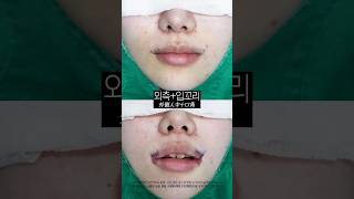 인중 입꼬리 수술 직후 모습 #외측인중 #입꼬리