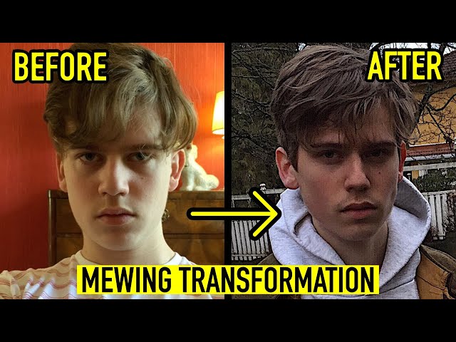 8 MONTH MEWING TRANSFORMATION VIDEO  19 YEARS OLD BEFORE AND AFTER 