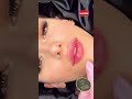 Lips Filler Hyomax 2cc فيلر شفا 2 مل هيوماكس 