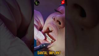 How are dental implants done on front teeth  shortvideo viral healthdental