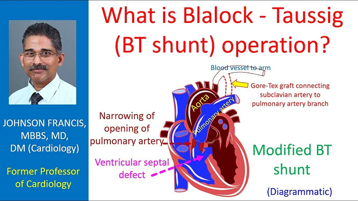 What is Blalock - Taussig (BT shunt) operation?
