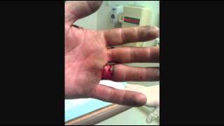 Wedding Ring Injury Scissor Lift Almost Lose A Finger Youtube Wedding Ring Injury Scissor Lift Almost Lose A Finger Youtube