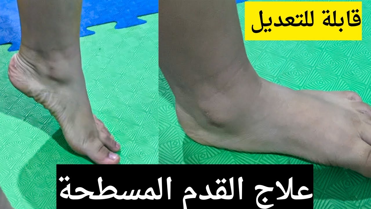 اصلاح القدم المسطحة  المرنة