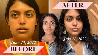 How I Reduced Swelling FAST | double jaw surgery