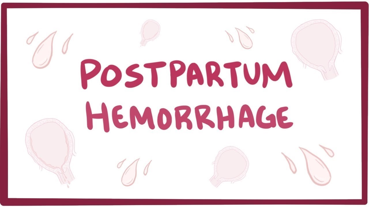 Postpartum Hemorrhage Causes Symptoms Diagnosis Treatment