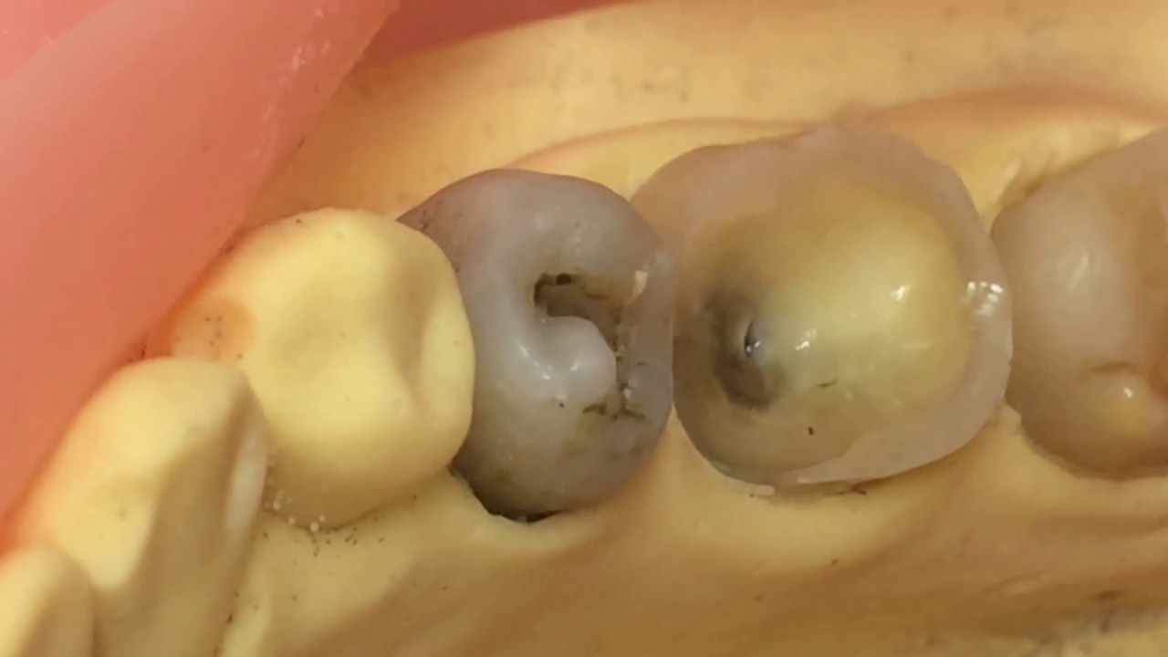 麻酔抜髄術式パーフォレーションしない手順 前半 インターネット歯医者さん 実践編