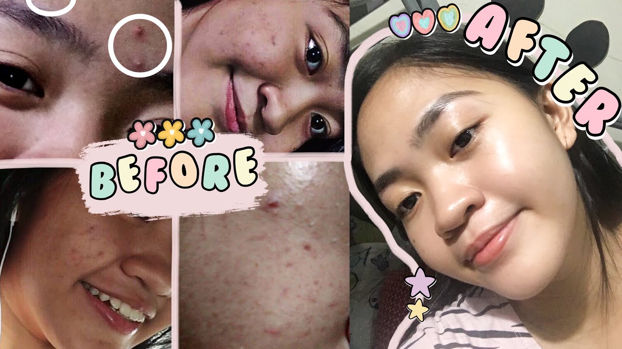 HOW I CLEARED MY SKIN?! PIMPLE / ACNE JOURNEY + 5-STEP SKINCARE ROUTINE ...