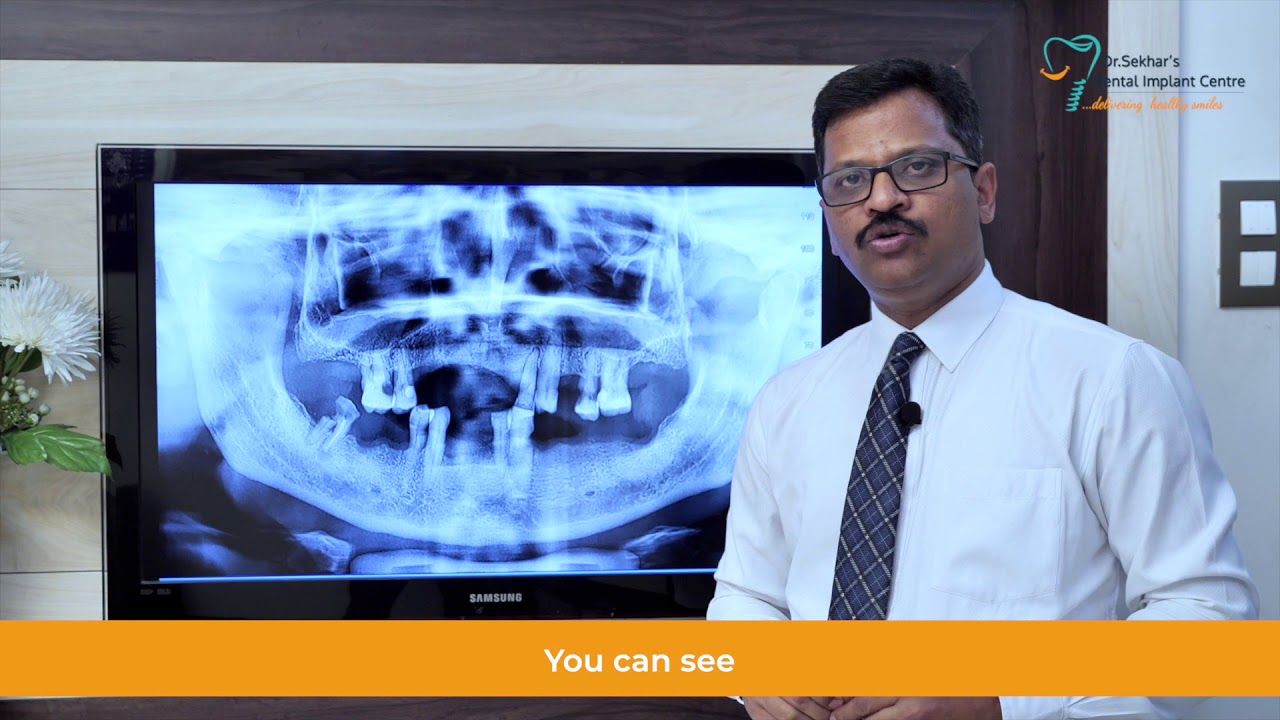 Best All on 4 Dental Implants in Hyderabad All on 4 Dental Implant