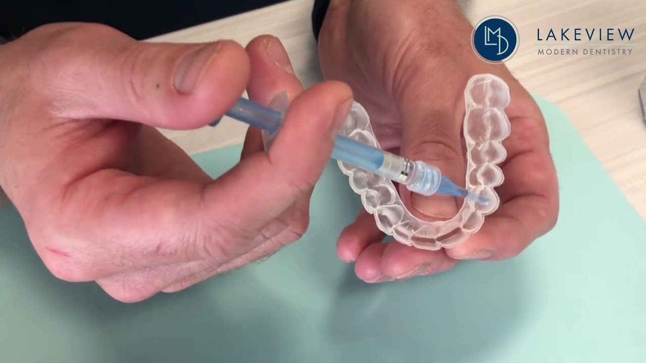 Take-Home Whitening Instructions