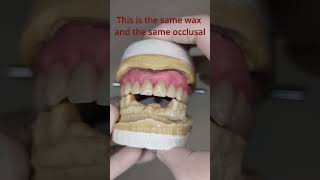Denture Wax Try-In