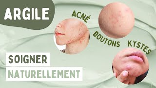 COMMENT SOIGNER NATURELLEMENT ACNÉ, BOUTONS & KYSTES GRÂCE À L'ARGILE ??‍️  [+RECETTE MASQUE DIY]