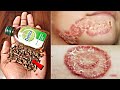 80 साल पुराने दाद खाज खुजली की 60 सेकंड में छुट्टी कर देगा,fungal,daad khujli treatment solution