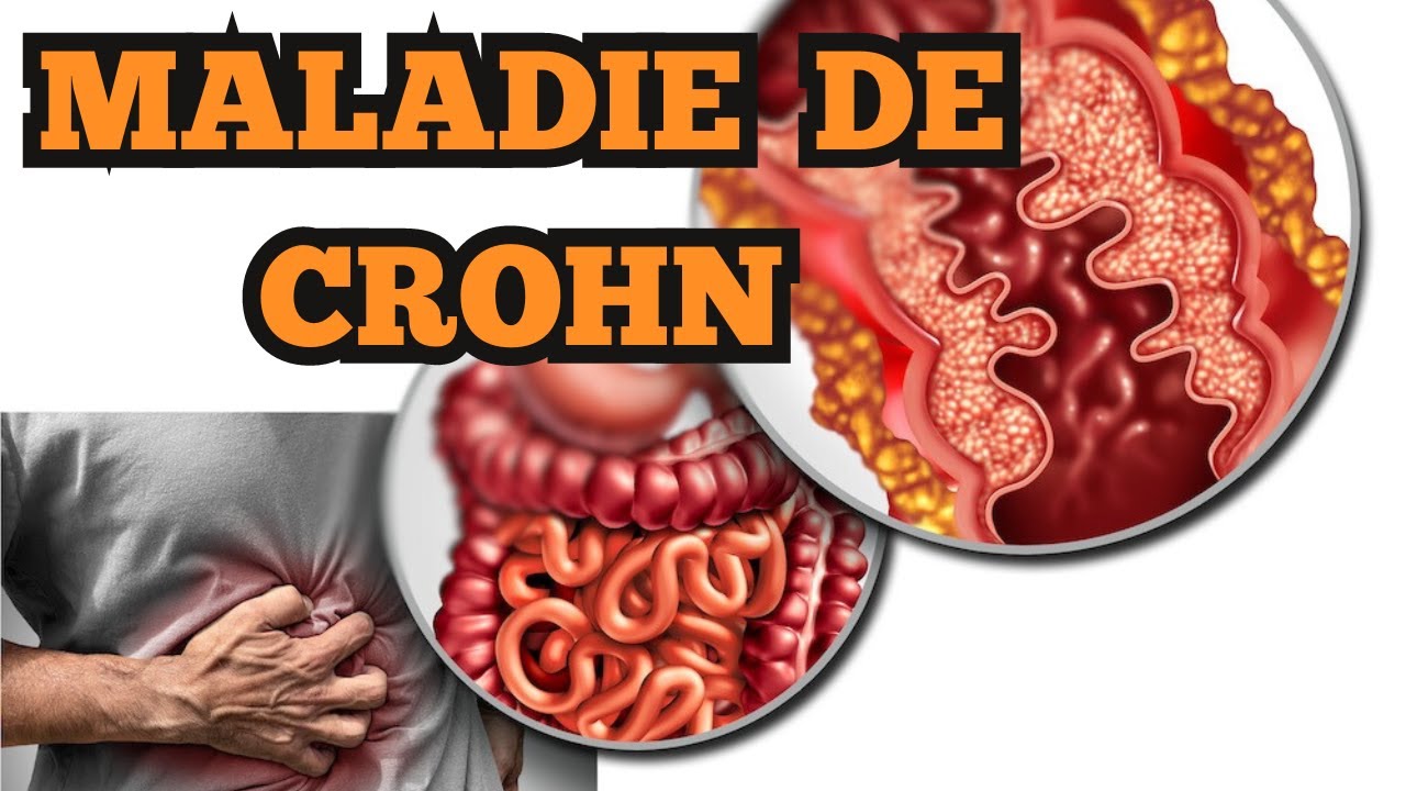 La Maladie de CROHN Causes et symptomes les plus fréquents — free download