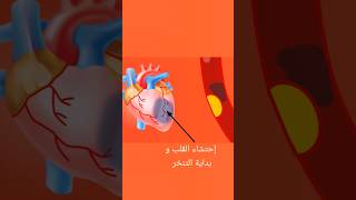 كيف تحدث النوبة القلبية /3D/ ... ؟ #شورت #امراض_القلب #نوبة Resimi