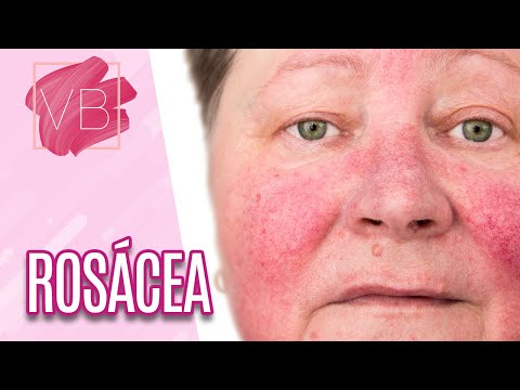 Vídeo: Rosácea No Rosto - Causas, Sintomas E Tratamento