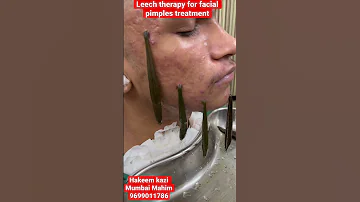 Leech therapy for face benefits? 8 sepA12 #leechtherapy#leech#kzhijama#pimples#acne#scar#skin#shorts