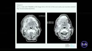 Engineering Blood Cells in the Fight Against Cancer & Other Diseases - Stephen Schoenberger
