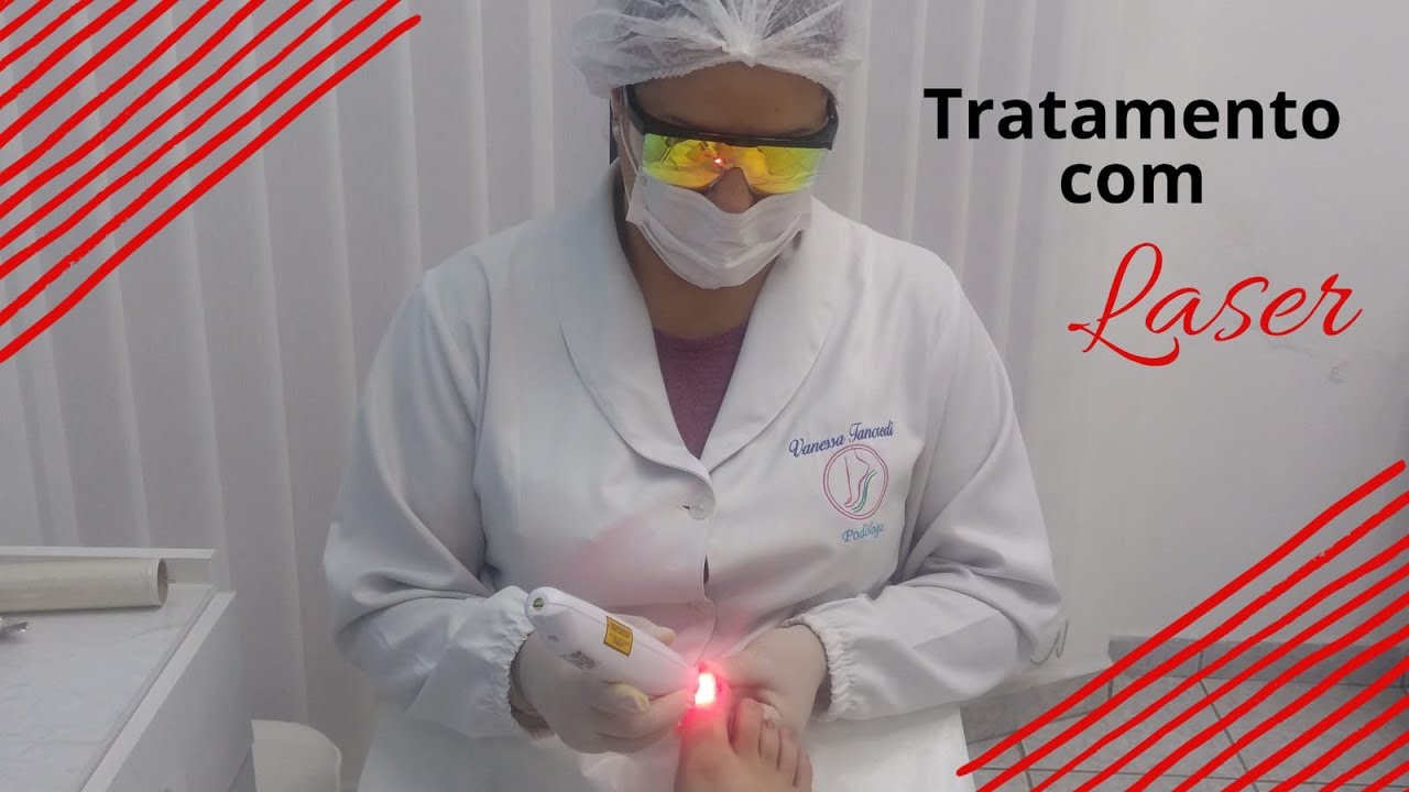 Laserterapia na podologia
