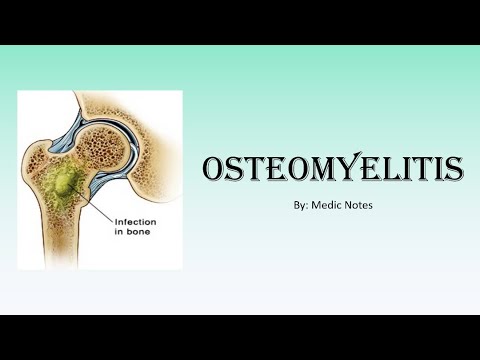 Video: Hvilken er den vanligste årsaken til hematogen osteomyelitt?