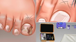 asmr toenail cleaning animation | asmr skin care routine | toenail cleaning  | asmr @Kpasmrtv