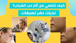 ندبات حب الشباب    اثار حب الشباب   حفر الوجه اتخلصي من كل ده و  باسرع طريقه